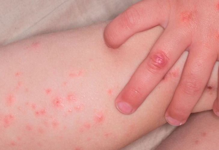 Confirman un caso de sarampión en Santa Fe: un bebé de 11 meses | Noticias