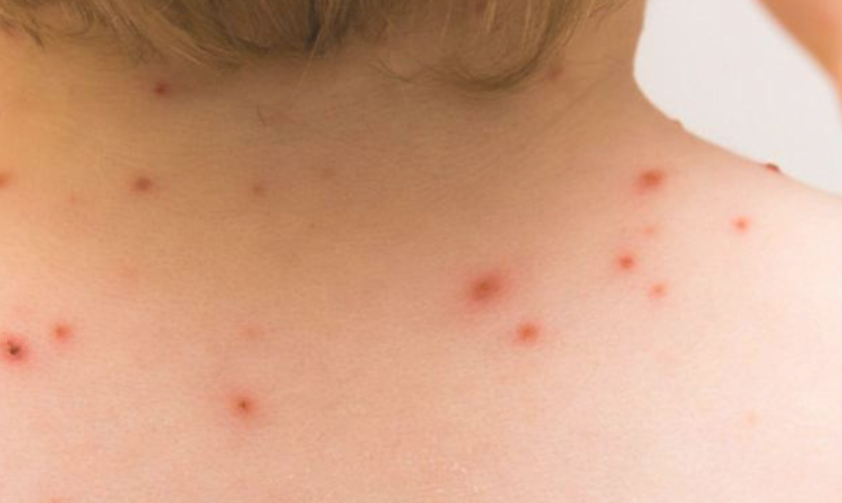 Se confirmó el primer caso de viruela del mono en la provincia | Noticias