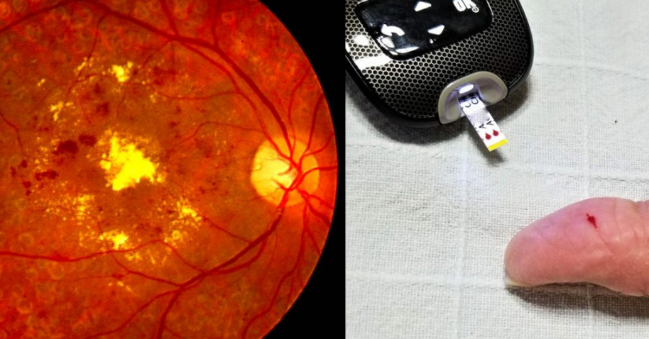 Santa Fe adhiere a la Campaña Nacional de Prevención de Retinopatía Diabética | Información General