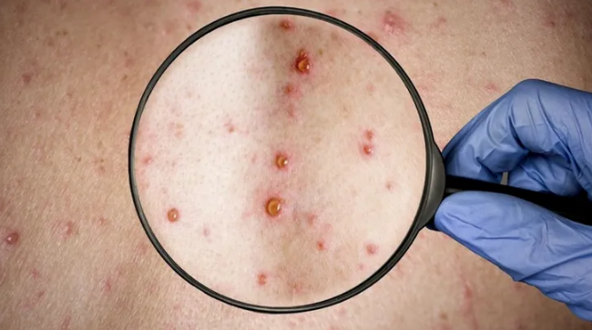 Viruela del mono: Se confirmó la segunda muerte en Argentina | Nacionales