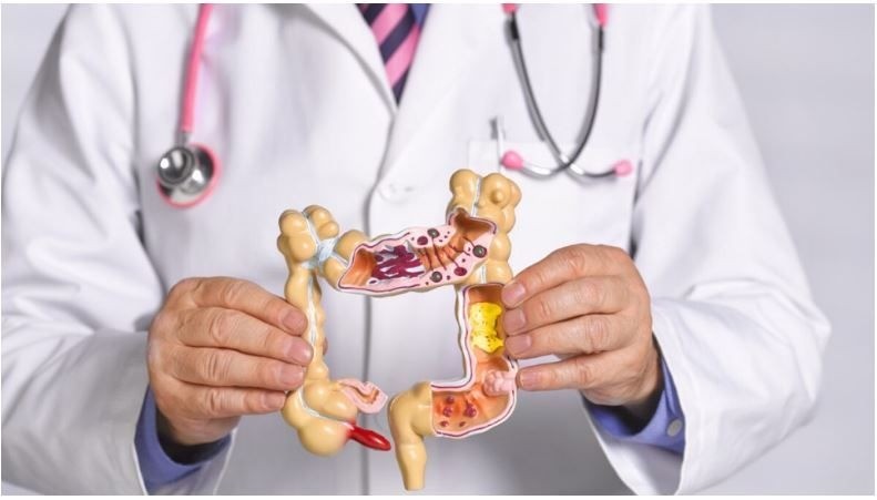 Día Mundial del Cáncer de Colon: la importancia de la consulta temprana | Salud