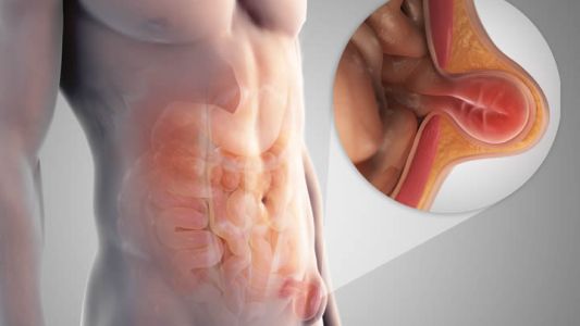 Cómo prevenir y tratar hernias abdominales