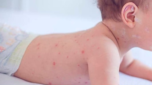 Sarampión: Desde Salud brindaron algunas recomendaciones especiales