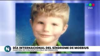 ¿Qué es y qué produce el Síndrome de Moebius?