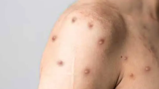 Dos nuevos casos sospechosos de viruela del mono en Rosario