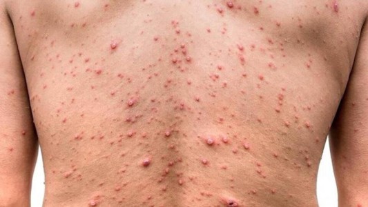 Viruela del mono: el caso santafesino es una mujer que no tiene antecedentes de viaje