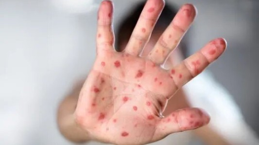 Alerta por Viruela del mono en Argentina: confirman el sexto caso