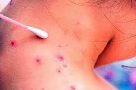 Dio negativo la sospecha de caso de viruela del mono en la provincia