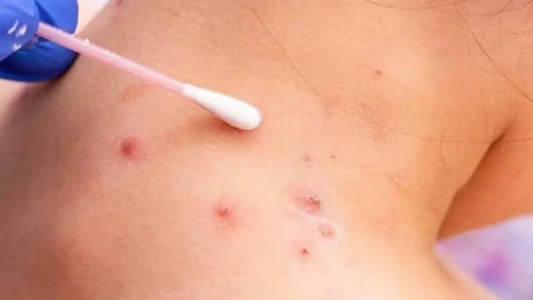 Se detectaron más de 20 casos de viruela del mono en Argentina