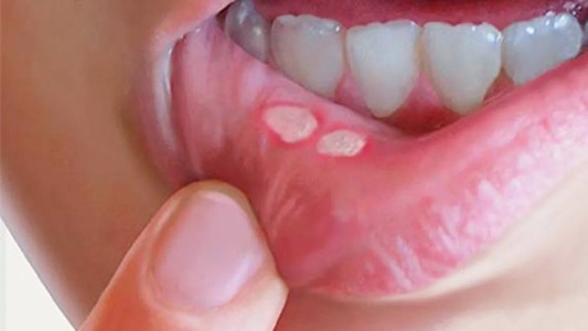 Crecieron los contagios de sífilis en Argentina: Santa Fe es el tercer distrito con más casos