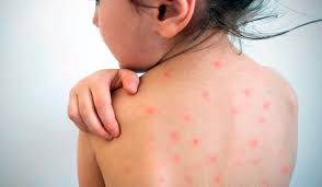 Sarampión: se confirma caso en Entre Ríos y la provincia refuerza los controles