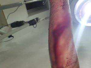 Un trabajador de la EPE fue atacado por perros y sufrió múltiples mordeduras