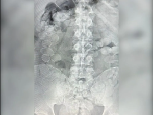 Condenan a dos hombres por transportar cocaína ingerida en cápsulas en Santa Fe