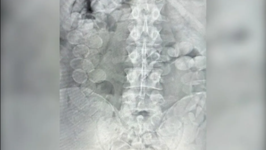 Condenan a dos hombres por transportar cocaína ingerida en cápsulas en Santa Fe