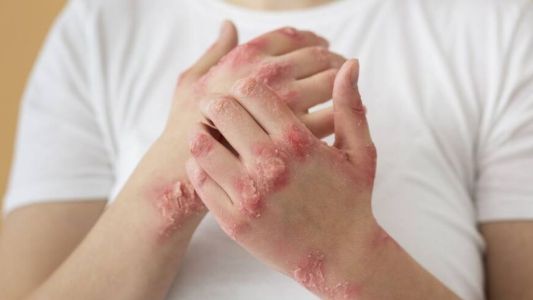 Alarma por el aumento de sífilis en jóvenes: crecen los casos en la Región Centro