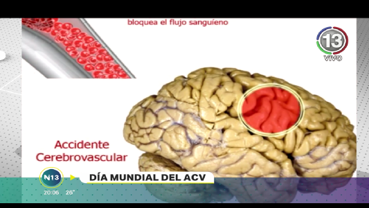 CAMPAÑA DE PREVENCIÓN DEL ACV