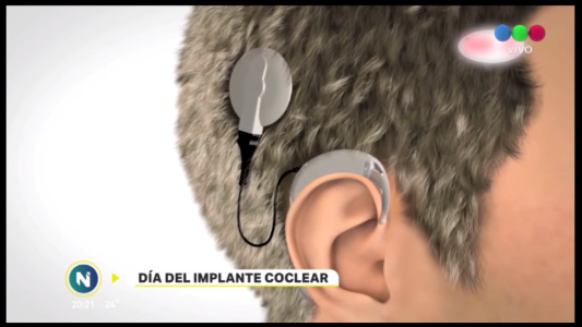 Día del implante coclear