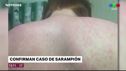 Confirman caso de sarampión