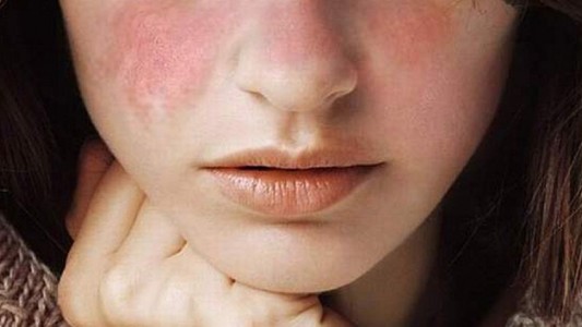 Dìa mundial del Lupus: una enfermedad autoinmune que afecta a 28 mil argentinos