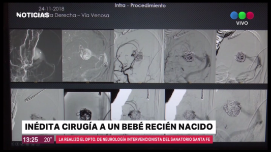 Inédita cirugía cerebral a un bebé recién nacido: