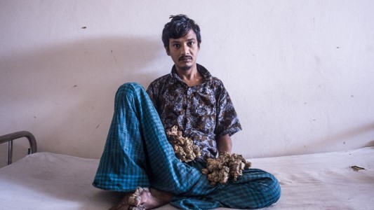 "Ya no soporto el dolor": el "hombre-árbol" pidió que le amputen las manos