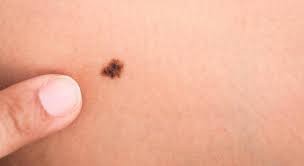 Melanoma: cómo prevenir y tratar el cáncer de piel