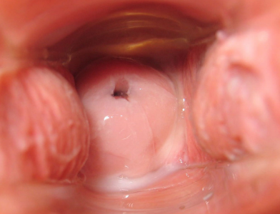 La patología del cuello uterino