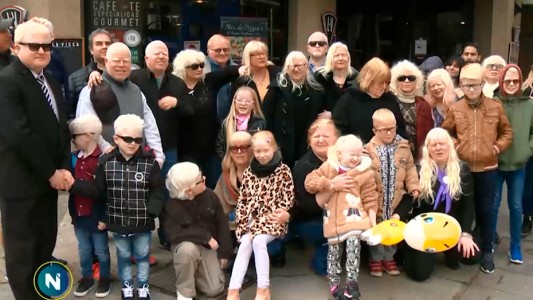 Mundo albino: cómo es la vida de los argentinos que tienen esta condición genética