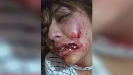 Un joven atacó a su novia y le arrancó parte del labio