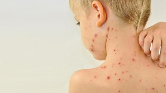 Confirmaron 18 casos de sarampión y ordenan ampliar la vacunación