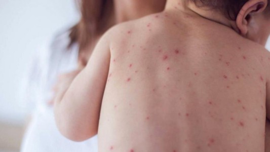 Una mujer antivacunas le contagió el sarampión a sus cinco hijos