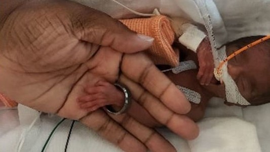 La milagrosa recuperación de la bebé prematura que nació pesando 370 gramos