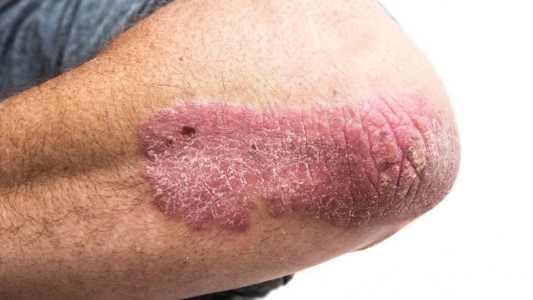 Acciones especiales en Santa Fe por el Día Mundial de la Psoriasis