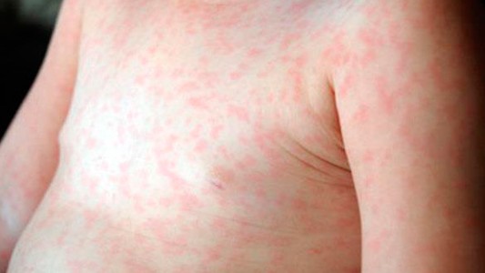 Se confirmaron que ya son 61 los casos de sarampión