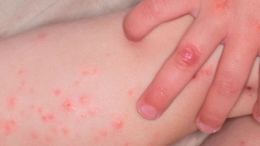 Confirman un caso de sarampión en Santa Fe: un bebé de 11 meses