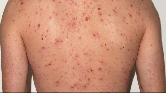 Recomiendan extremar los cuidados por el sarampión