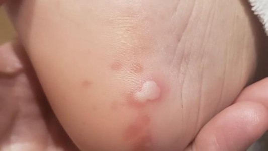 Estudio: las cinco manifestaciones del coronavirus en la piel de los enfermos