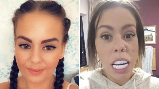 Quería tener una sonrisa perfecta, compró una dentadura por Internet y ahora no puede cerrar la boca