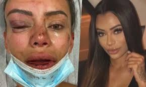 Una joven influencer relató en Instagram la paliza que le dio un hombre en una fiesta