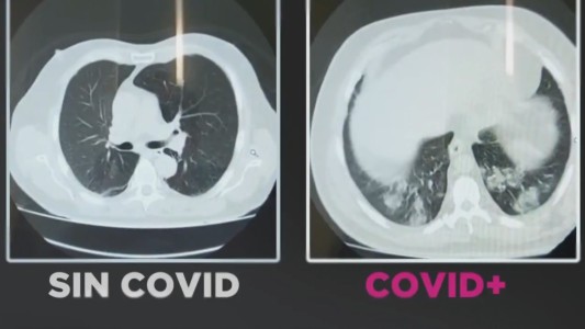 Para tomar conciencia: así se ven los pulmones con y sin coronavirus