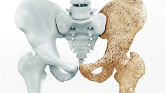 Advierten que la osteoporosis también afecta a los hombres