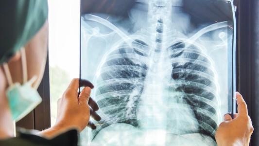 Día internacional de la lucha contra el cáncer de pulmón: ¿qué hay que saber?