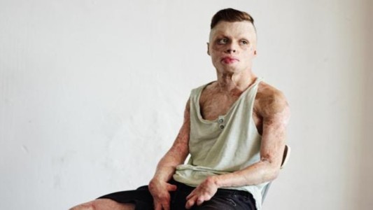 "Niño de fuego": el joven que sobrevivió tras quemarse el 90% del cuerpo
