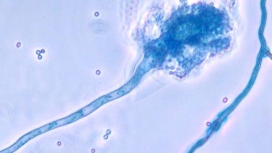 Estudio: científicas argentinas detectan un hongo que causa infección en pacientes graves con coronavirus