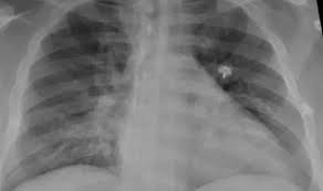 Qué es la neumonía bilateral, la enfermedad que produce más internaciones y muertes en pacientes con Covid