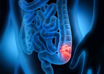 El Ministerio de Salud implementa un test para la prevención del cáncer de colon