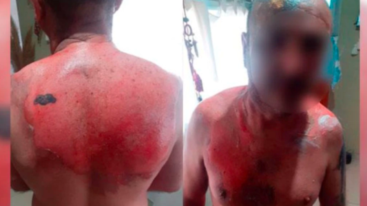 Un hombre fue atacado por su expareja con agua hirviendo