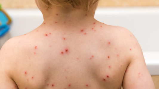 Enfatizan en la necesidad de completar esquemas de vacunación contra el sarampión