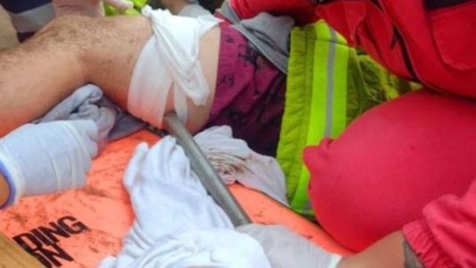 Video | Una sombrilla voló por la playa, se clavó en la pierna de un joven y se la sacaron con una motosierra