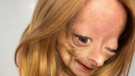 Murió Adalia Rose, la youtuber que padecía envejecimiento prematuro